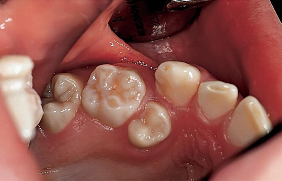 Photo of maxillary second premolar erupting in the palate due to crowding.