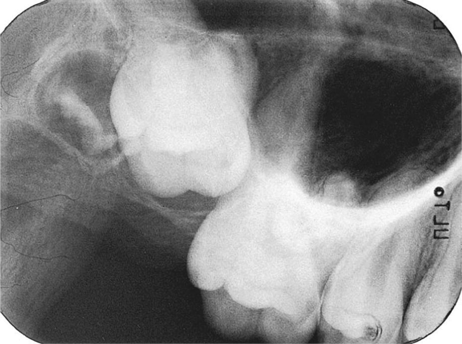 Radiograph of ectopically positioned maxillary 3rd molar disturbing eruption of second molar, with curved roots of impacted tooth too close to the sinus.