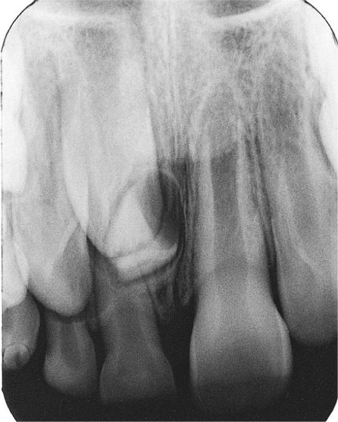 Radiograph of mesiodens interfering with eruption of central incisor in a 10-year-old boy.