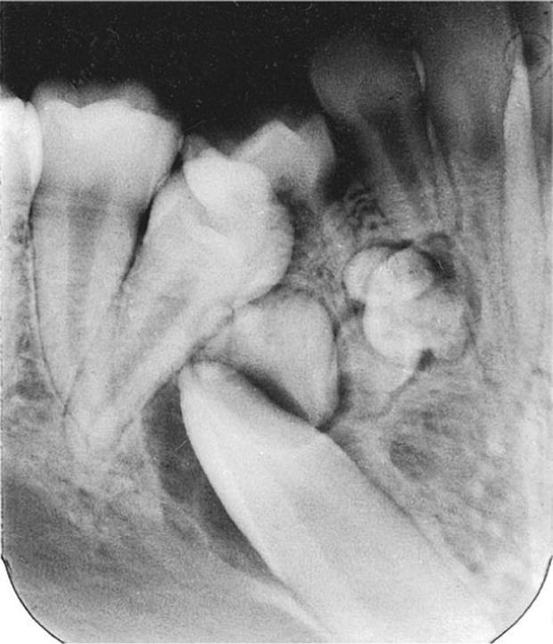 Radiograph of odontoma interfering with eruption of permanent mandibular canine.