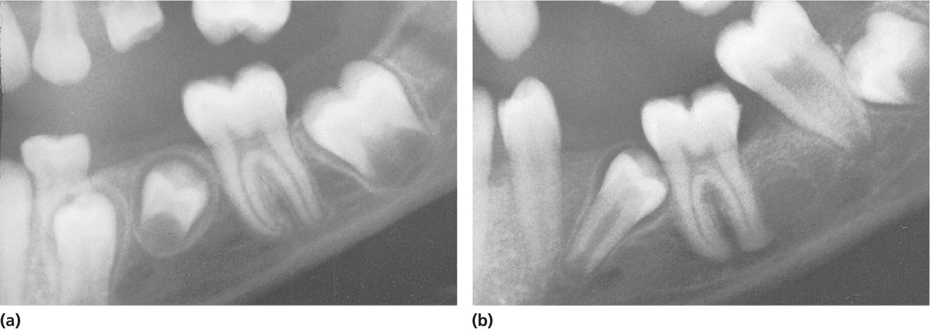 Radiographs of several teeth in ankylosis (left) and the same radiograph 4 years later with severe infraocclusion and ankylosis verified (right).