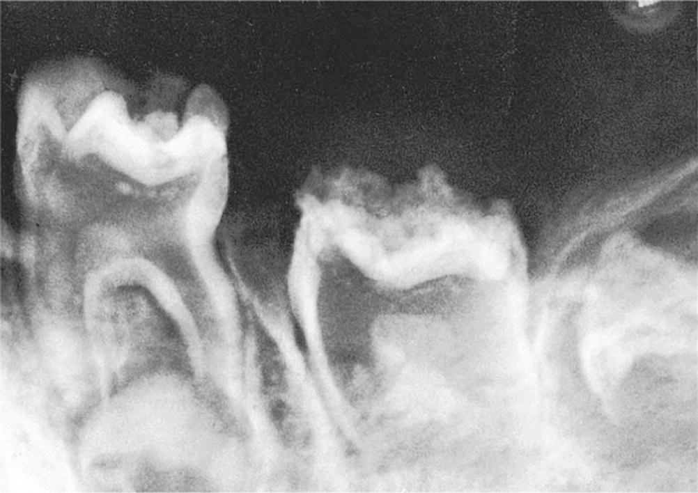 Radiograph of odontodysplasia resulting in ceased eruption both in primary and permanent dentition.