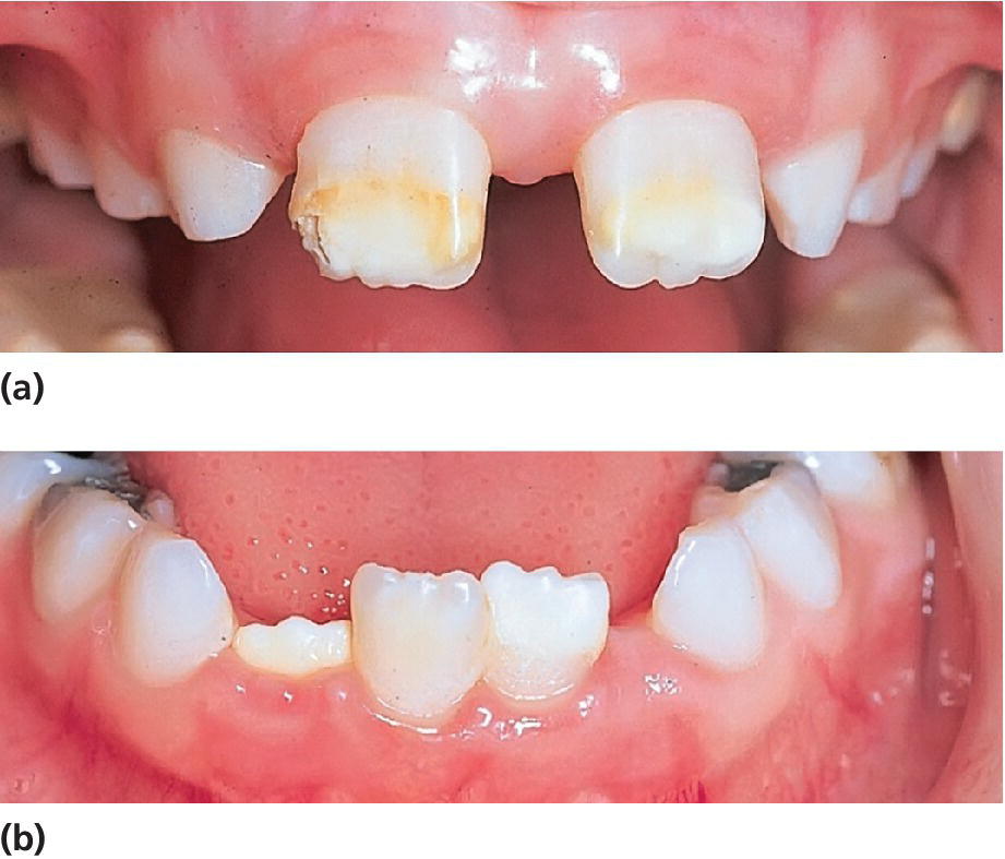 Two photos displaying severe hypomineralization of permanent maxillary and mandibular incisors with extensive opacities on 21, 31, and 41 and discoloration of 11.