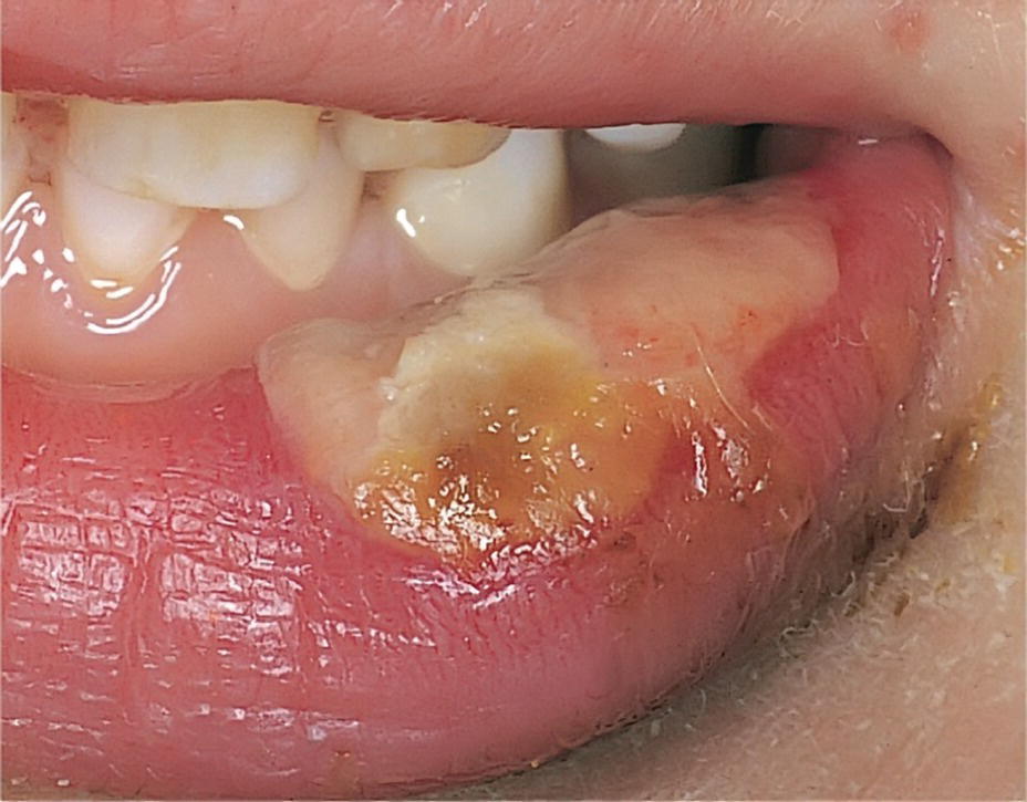 Photo displaying bite wound in the lower lip.