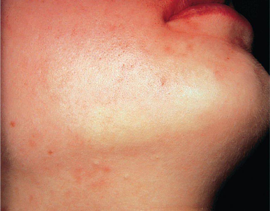 Photo displaying blanching of the cheek (sympaticus reaction) after local analgesia injection in a child.