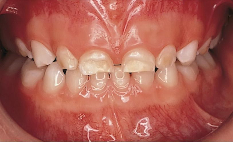 Photo of teeth of a preterm child with hypoplasia.