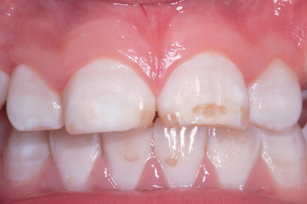 Photo of teeth and gums of a 12-year-old boy depicting dental fluorosis with posteruptive breakdown of the enamel and tooth wear.