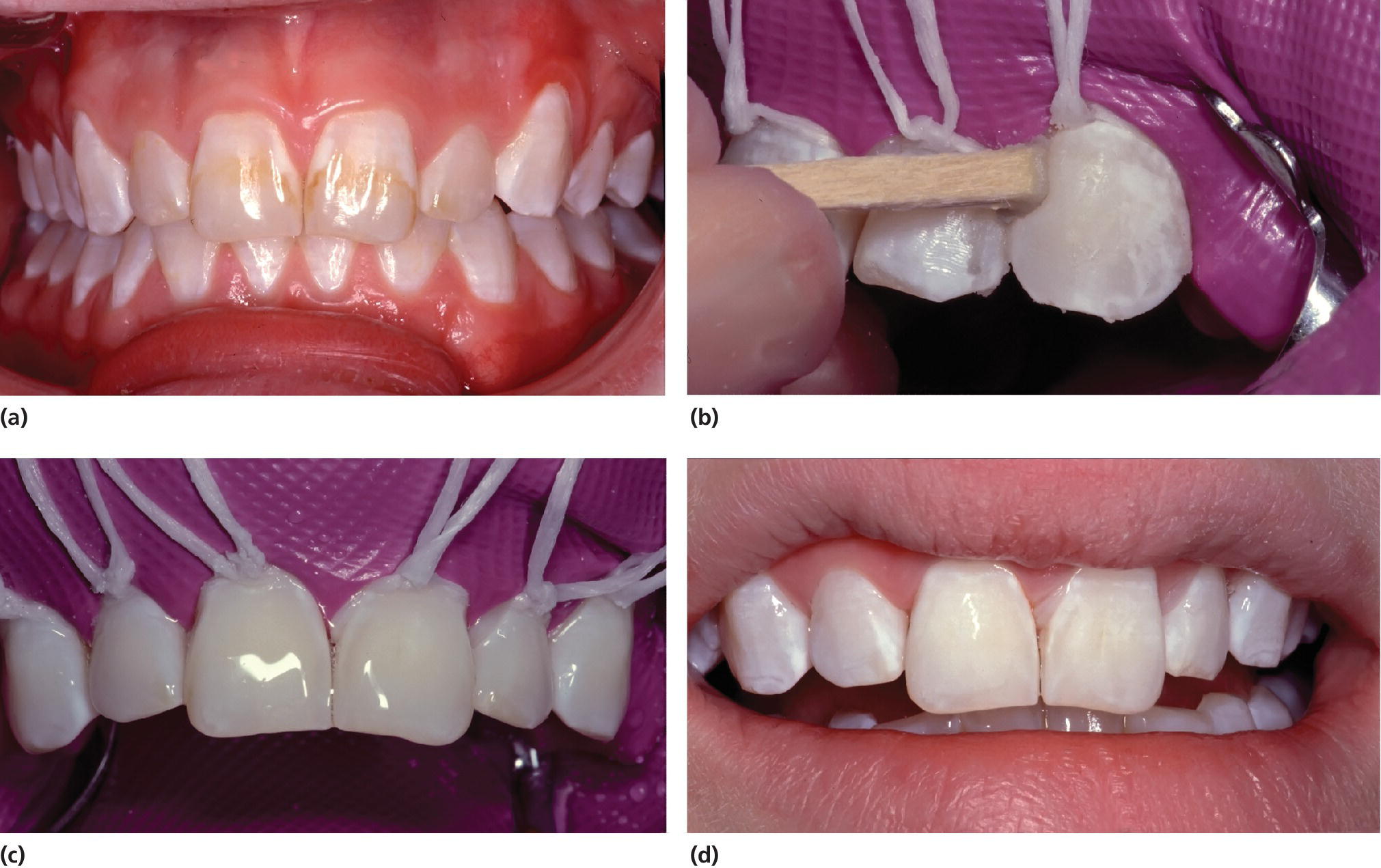 4 Photos of teeth of a 14-year-old girl, displaying mild dental fluorosis, the surface rubbed using a wooden pin and covered by sodium fluoride gel, and the treatment result.