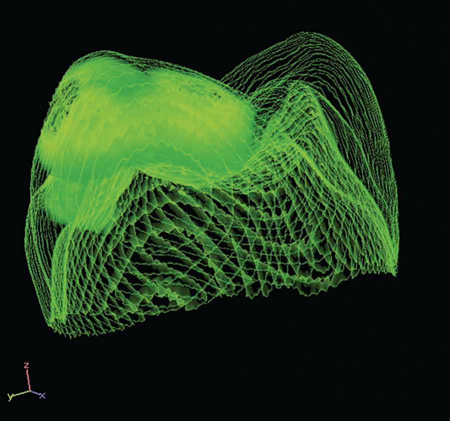 X‐ray micro‐computed tomography image of a MIH tooth. The more opaque areas represent hypomineralized enamel.