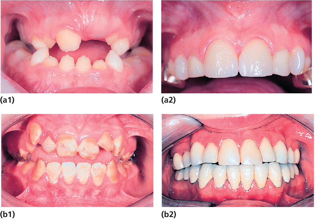 4 Photos displaying dentitions of, a 9-year-old girl with AI and at 14 years old with incisors restored, and a 12‐year‐old boy with AI and at 20 years old with metalloceramic and gold crowns in the mandible.