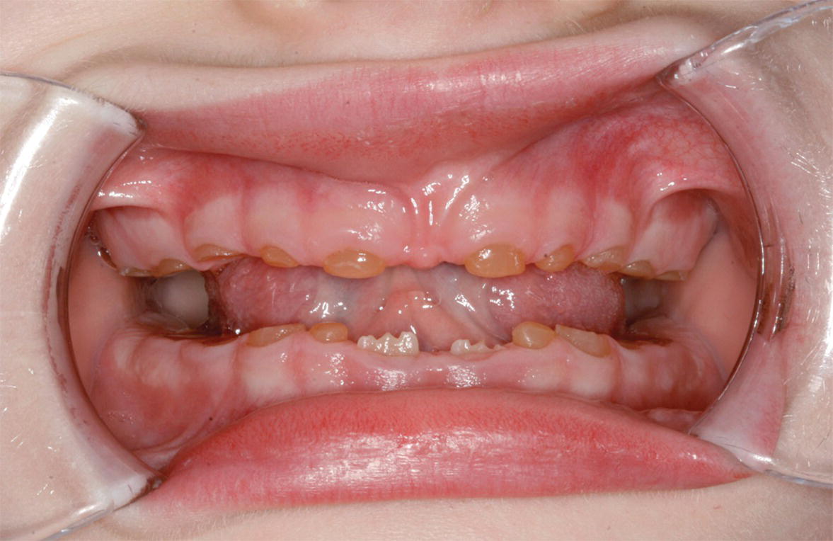 Photo displaying dentition of a 5‐year‐old child with DI with extreme tooth wear in the primary molars. Permanent lower central incisors are in eruption.