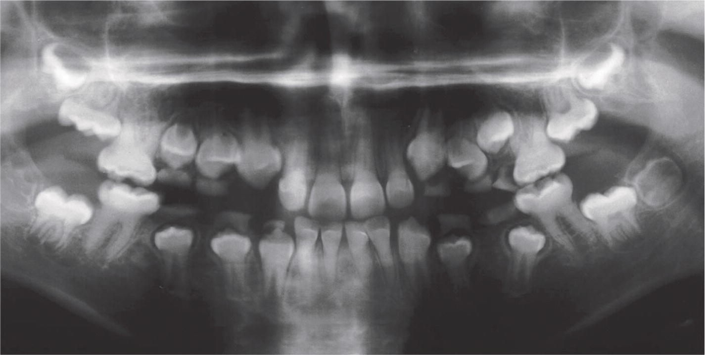 Panoramic radiograph of a 10‐year‐old boy with DI (type II). The obliteration of pulp chambers and the cervical constrictions of the crowns are evident.