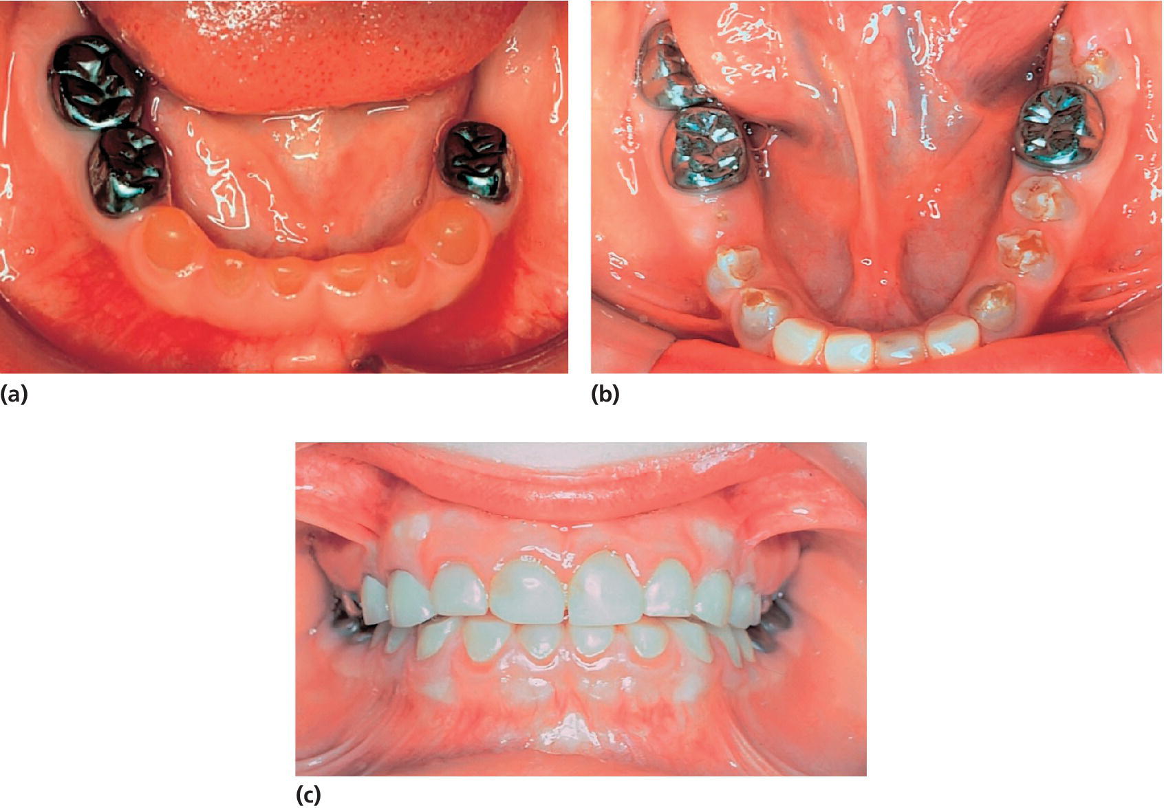 3 Photos displaying dentition of a boy with DI type II: mandibular teeth at the 3 years 5 months with stainless‐steel crowns, molars with crowns and incisors with composite crowns, then at the age of 10 years 4 months.