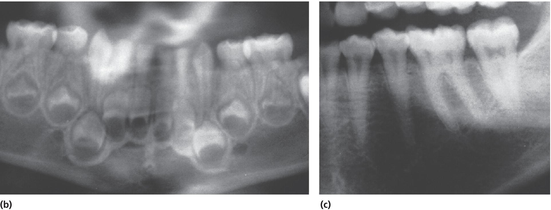 Left: Panoramic radiograph of a 3-year-old boy with pulpal obliteration in the primary molars. Bottom right: Radiograph of dentition of boy’s mother with characteristic pulp chambers and narrowed root canals.