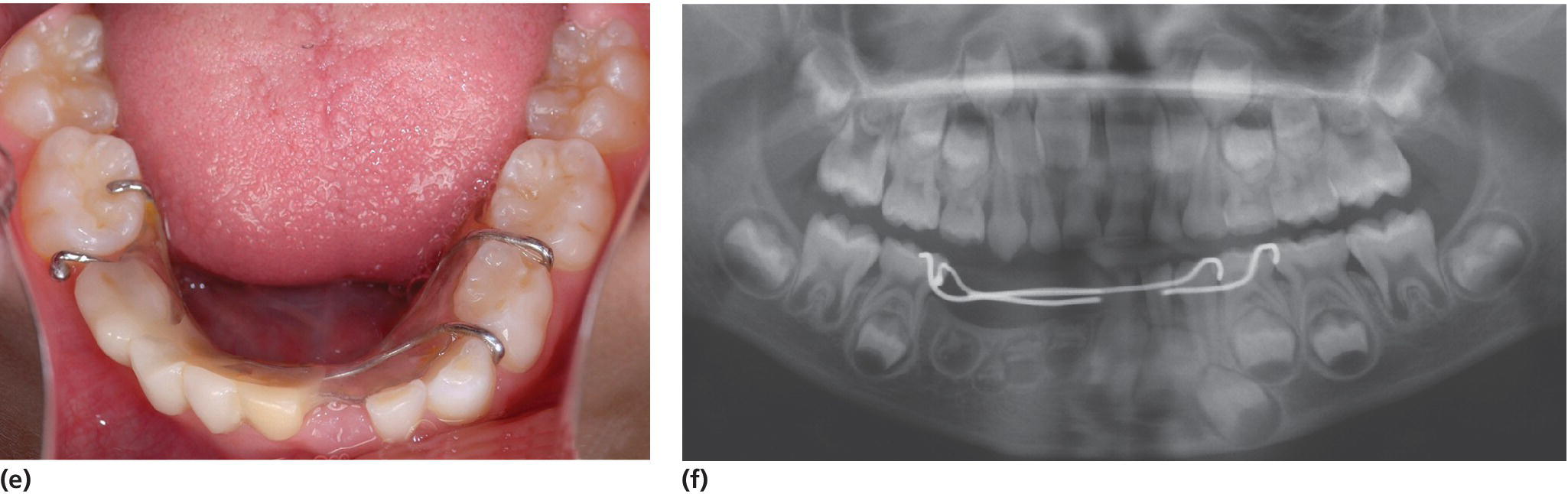 Photo displaying dentition of a 6-year-old with a denture inserted when the boy was 4 years old. It features the primary teeth having been gradually lost due to shedding. Panoramic radiograph displaying the affected successors. The denture was in place when the radiograph was taken as the retentive elements are visible on the photograph.