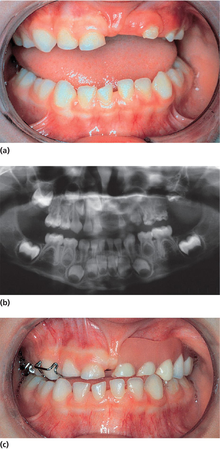 Top: Photo of abscessed incisors in maxillary left quadrant. Middle: Panoramic radiograph displaying involvement of all teeth in quadrant. Bottom: Photo of post-treatment via extraction except first molar.