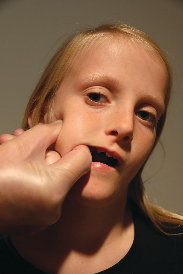 Photo of a patient with palpation of the anterior part of the superficial portion of the right masseter muscle.