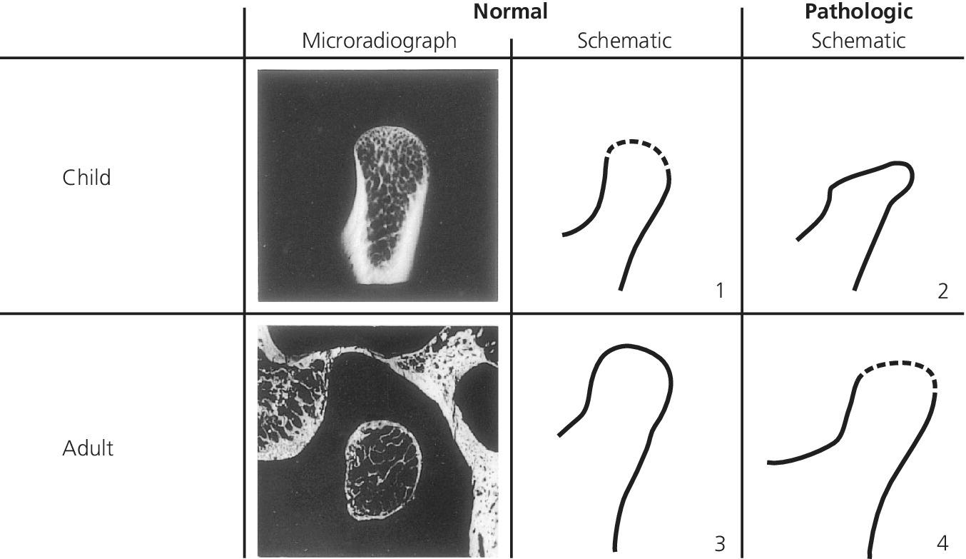 Schematic illustration of the apparent paradoxical peripheral delineation of the condylar heads of normal and pathologic joints in the child and the adult.