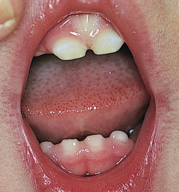 Photo of the dentition of a 3‐year‐old boy with a malabsorption syndrome. It features the erosive change on anterior teeth.