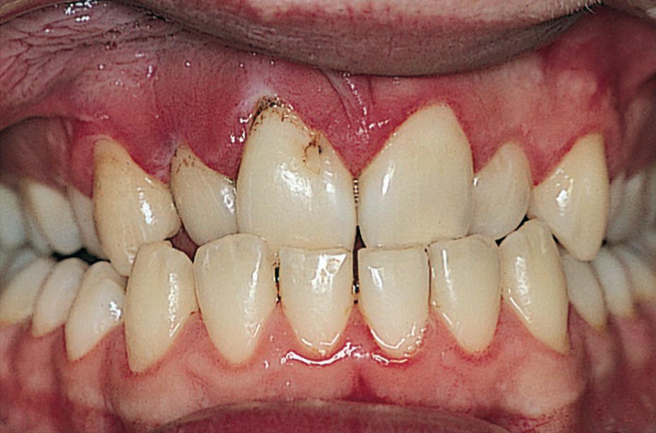 Photo of the dentition of a 16‐year‐old boy with severe obesity exhibiting high caries activity and extensive gingivitis.