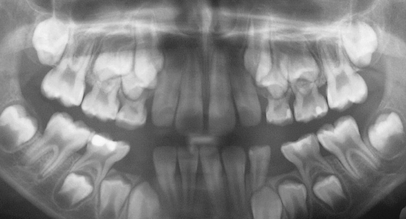 Panoramic radiograph presenting severe periodontal breakdown in a 6‐year‐old boy with cyclic neutropenia.