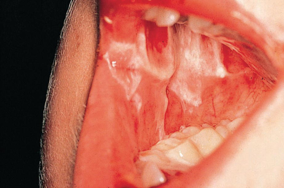 Photo of a severe oral ulceration in a 5‐year‐old boy during induction
chemotherapy for acute lymphoblastic leukemia.