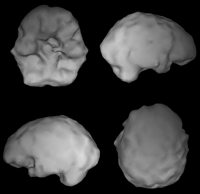 Surface SPECT scan showing uniform blood flow.