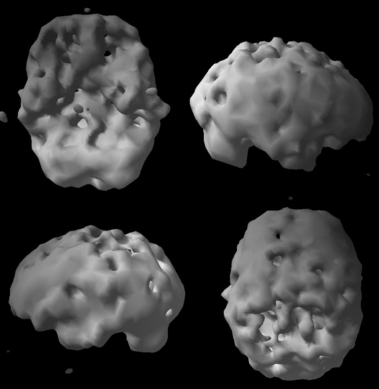 Surface SPECT scan showing areas of very low blood flow.