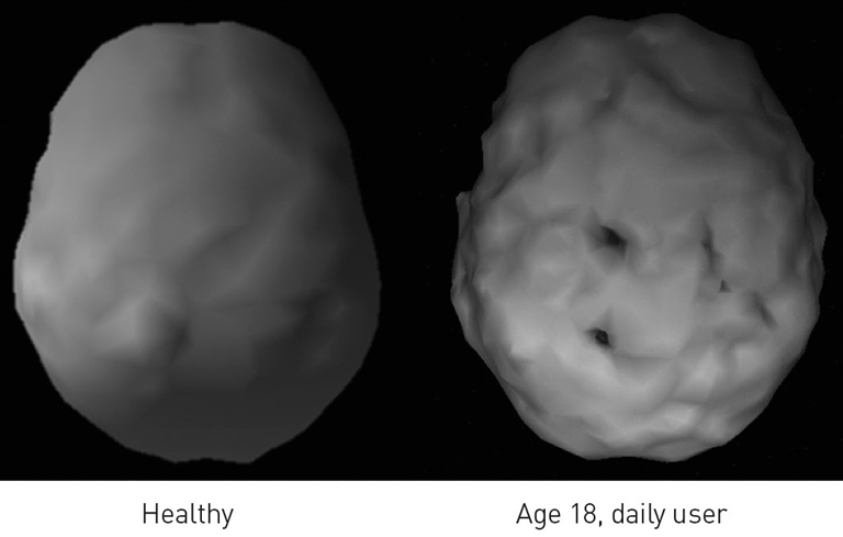 Two surface SPECT scans. The left is healthy, showing uniform blood flow. The right is of a daily marijuana user, age 18. It shows areas of very low blood flow.