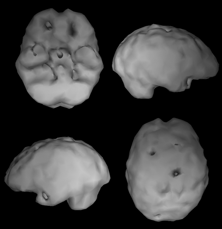 Surface SPECT scan showing areas of very low blood flow.