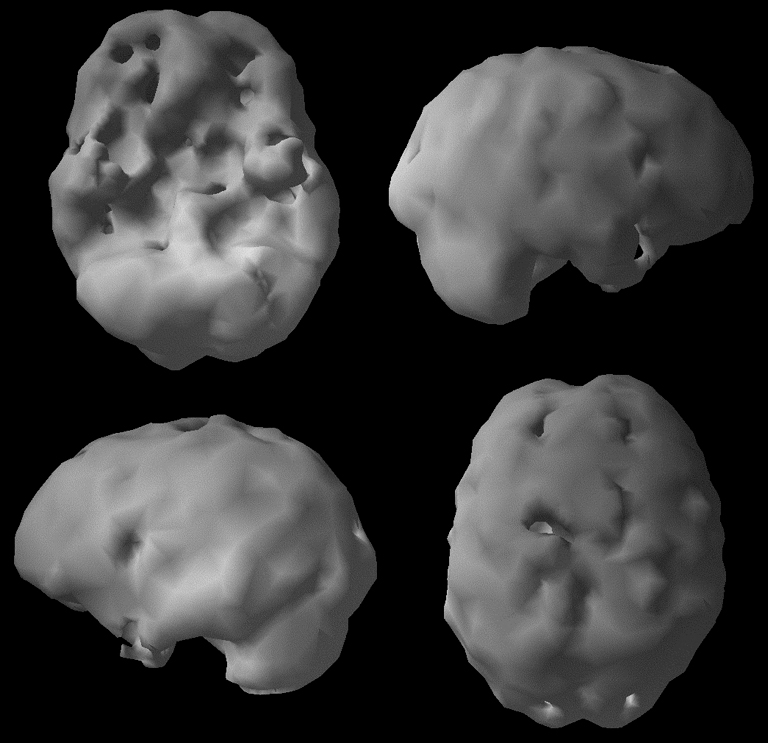 Surface SPECT scan showing areas of very low blood flow.