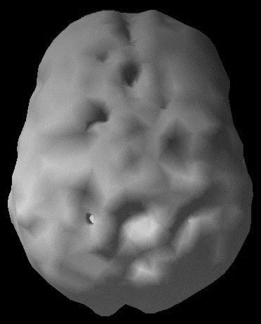 Surface SPECT scan showing areas of very low blood flow.