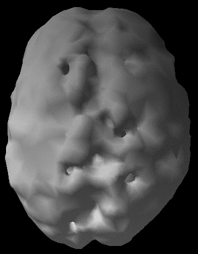 Surface SPECT scan showing areas of very low blood flow.