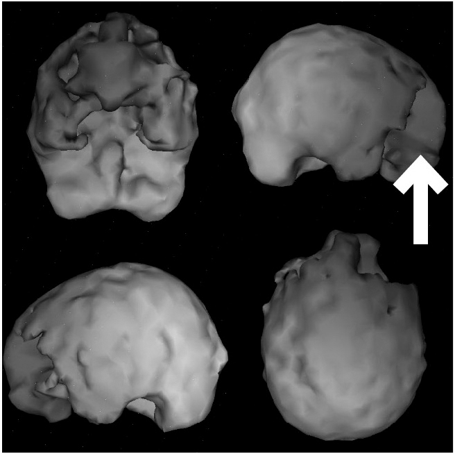 Surface SPECT scan showing areas of very low blood flow.