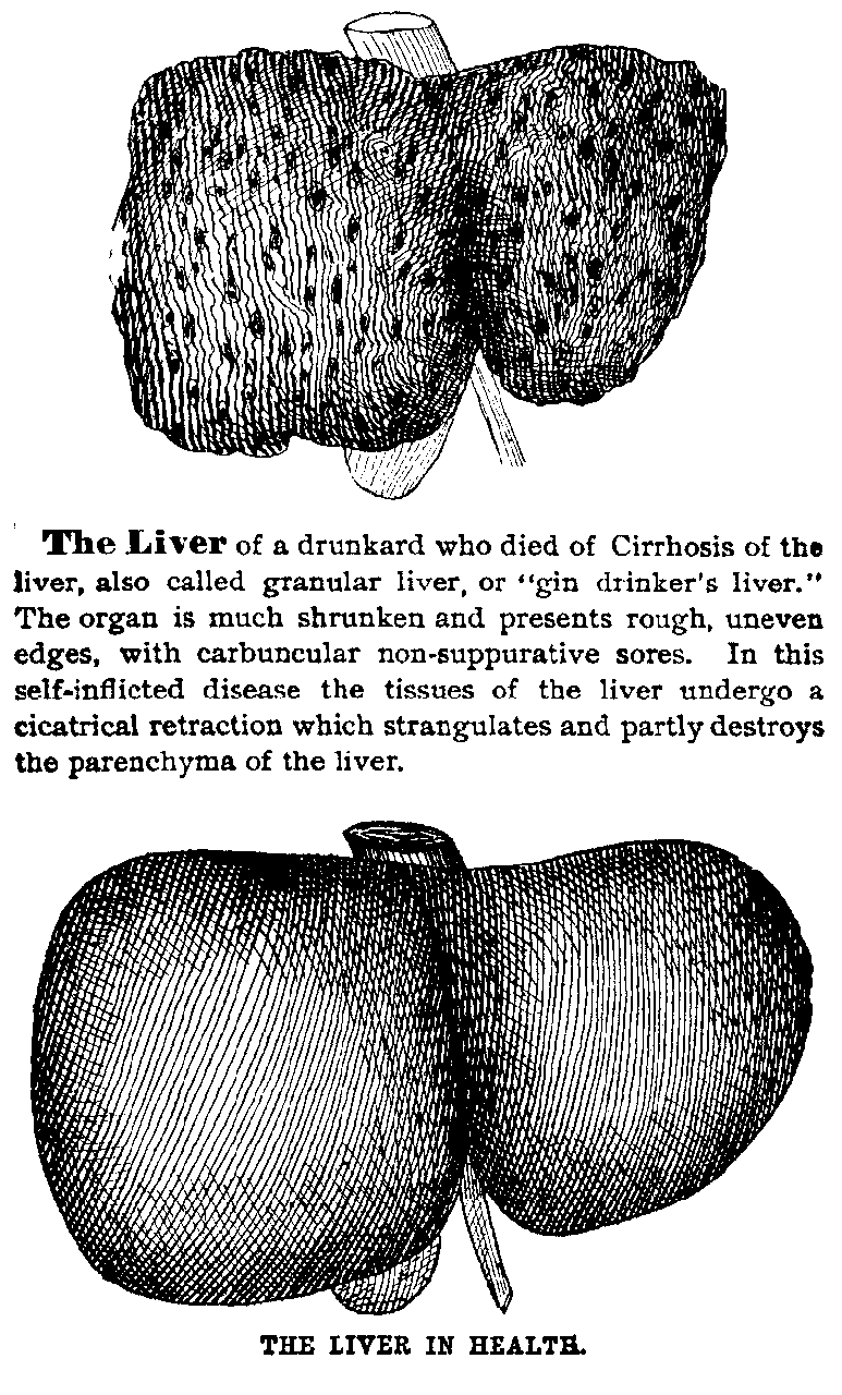 Line Drawings of a Diseased and a Healthy Liver