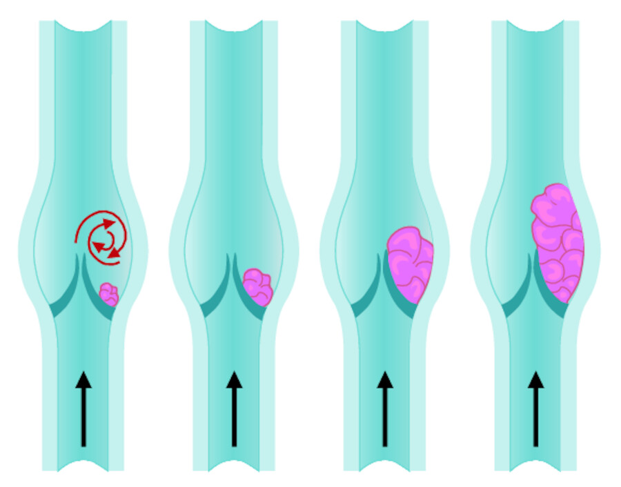 Thrombose.