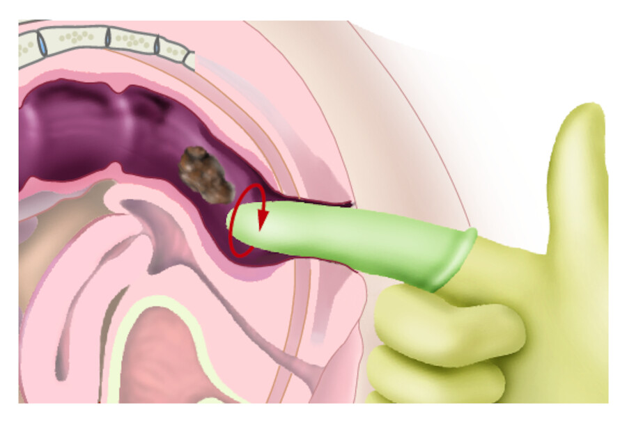 Digitale Ausräumung der Ampulle bei Obstipation.