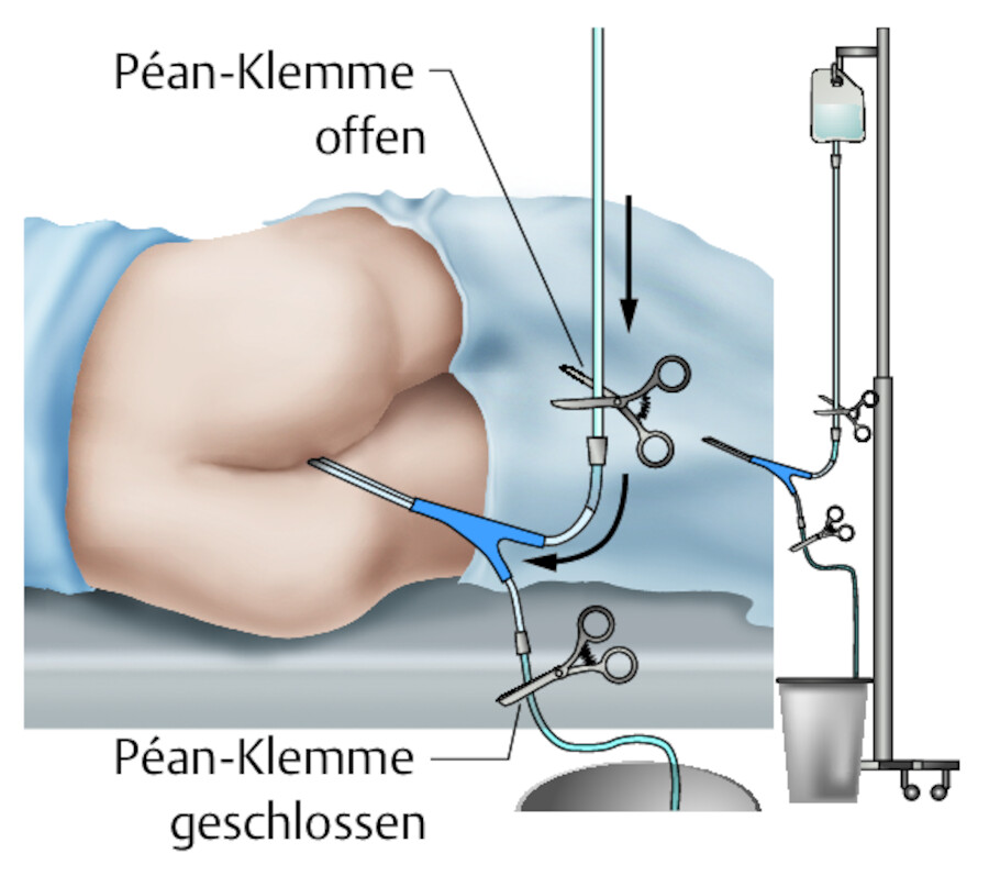 Durchführung einer Darmspülung.