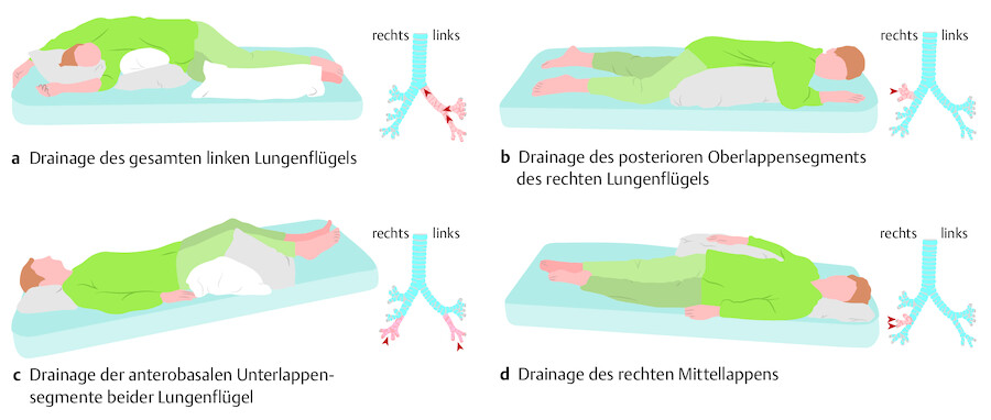 Drainagelagerungen.