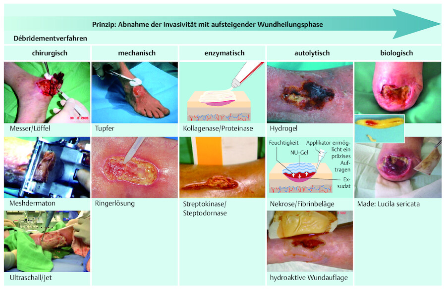 Möglichkeiten des Débridements. 