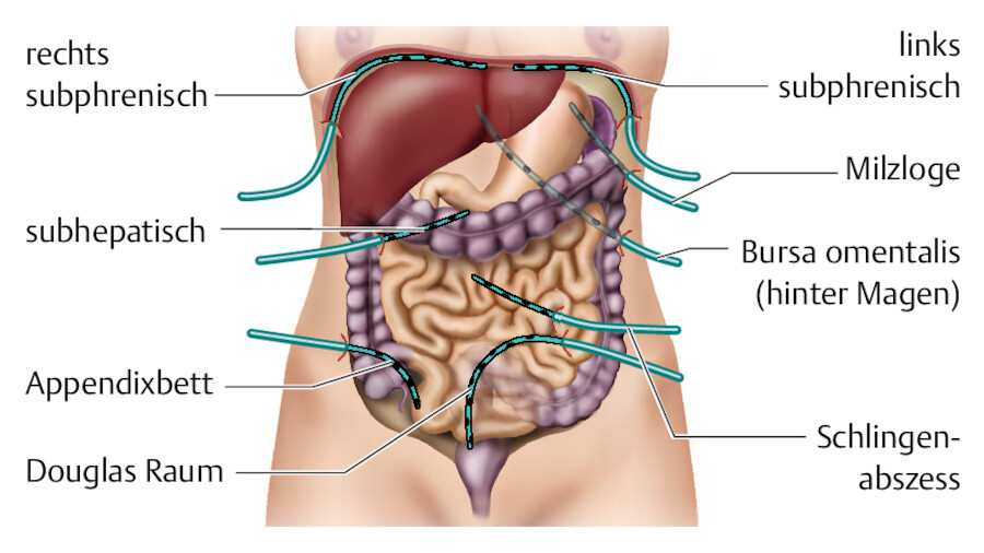 Häufige Lokalisationen von Drainagen in der Bauchhöhle.