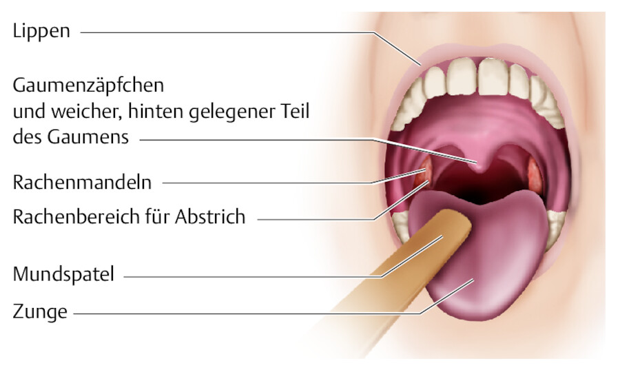 Rachenabstrich.