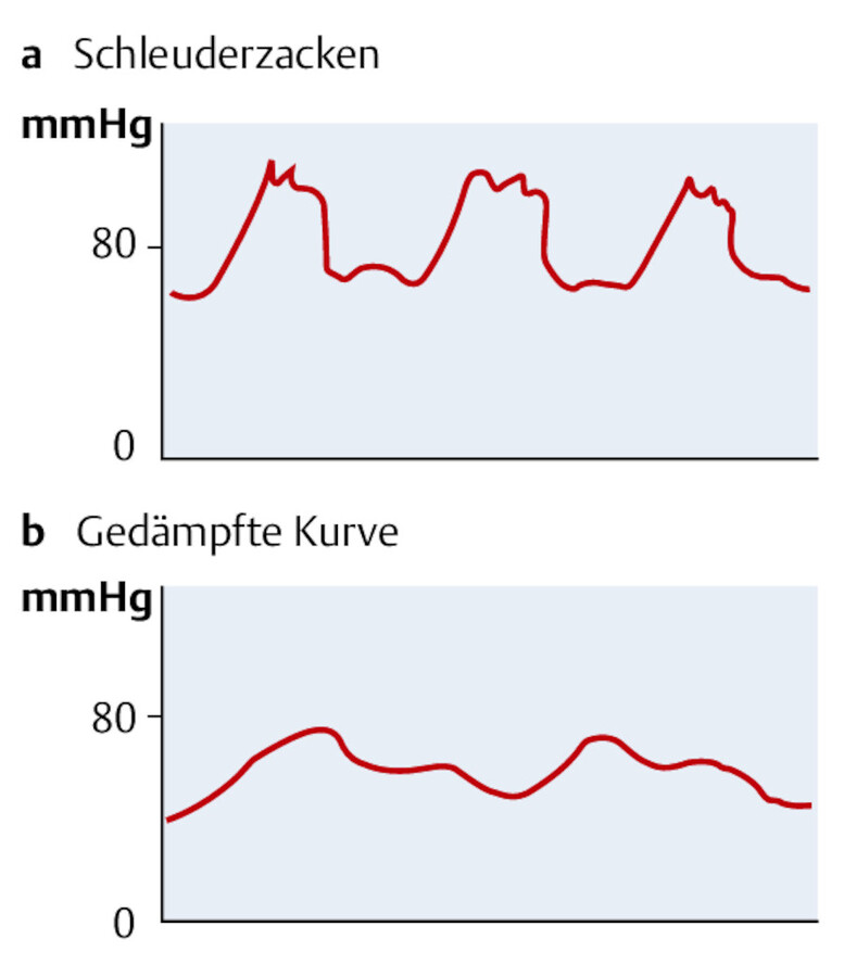 Arterielle Blutdruckmessung.