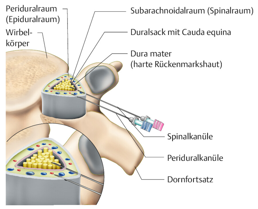 Periduralanästhesie.