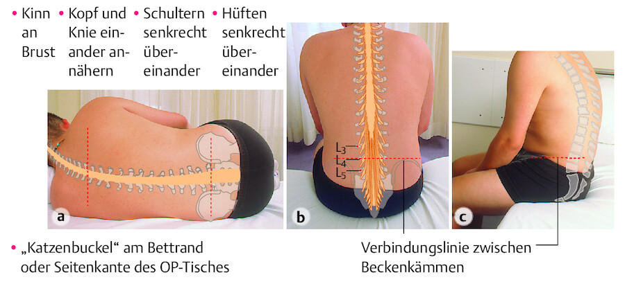 Lagerung des Patienten zur Spinalanästhesie.