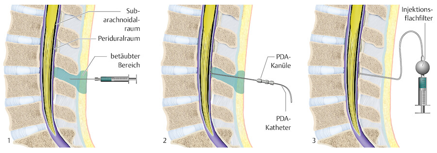 Durchführung der Periduralanästhesie.
