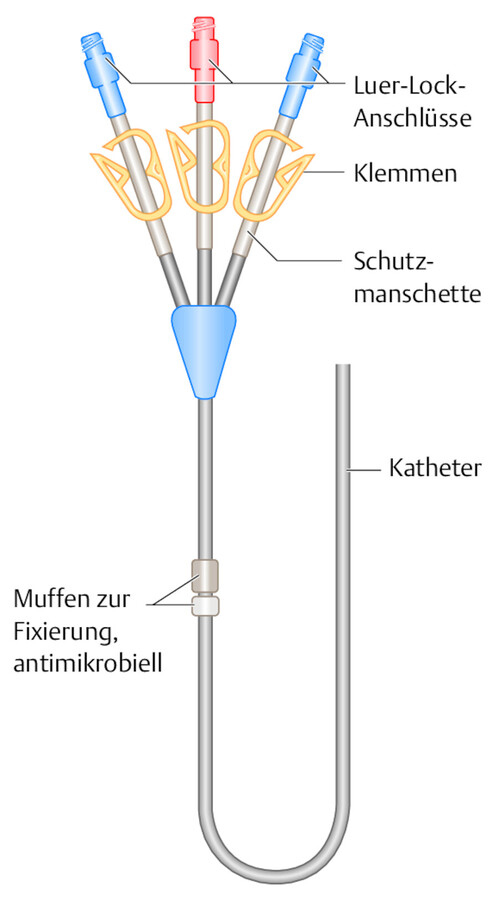 Hickman-Broviac-Katheter.