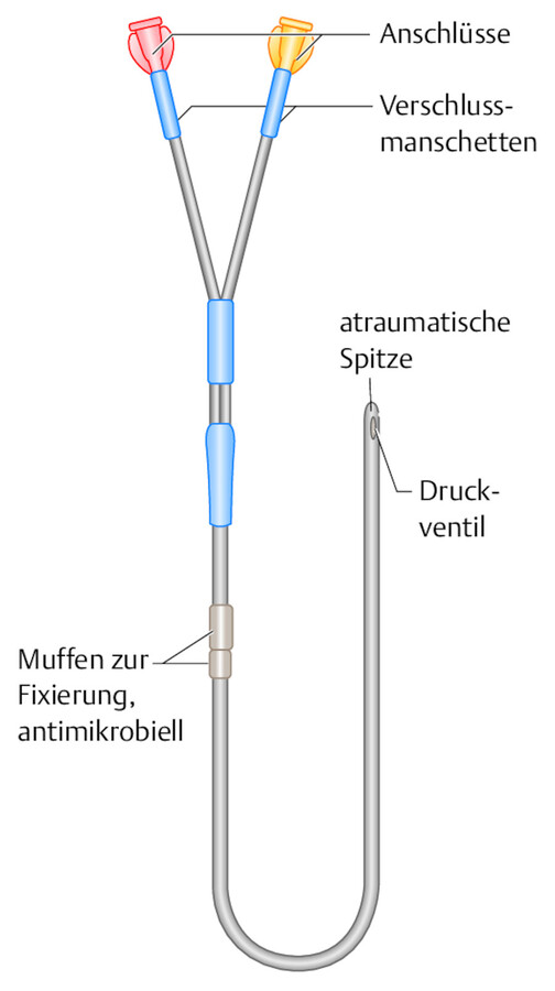 Groshong-Katheter.