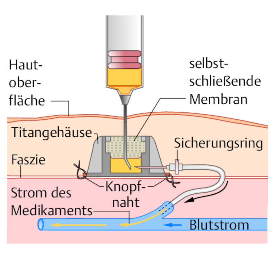 Einstich in das Port-A-Cath-System.