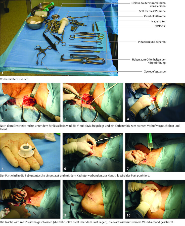 Diese Fotoserie zeigt, wie ein Port unter dem Schlüsselbein rechts an die V. subclavia angeschlossen wird.